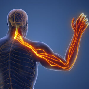 Can a Chiropractor Help a Pinched Nerve?