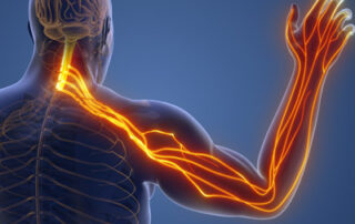 Can a Chiropractor Help a Pinched Nerve?